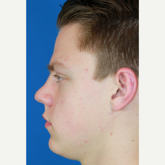 Male Rhinoplasty before 3684383