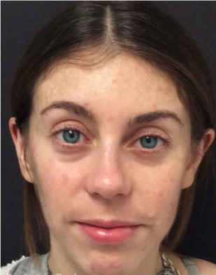25-34 year old woman treated with Restylane before 3836230