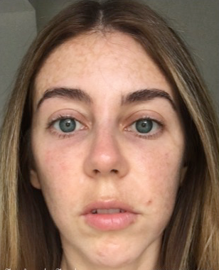 25-34 year old woman treated with Restylane after 3836230