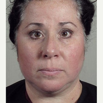 35-44 year old woman treated with Halo Laser after Ultherapy treatment. before 1909003