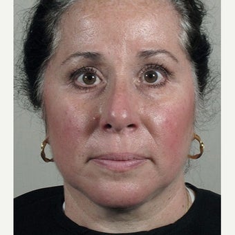 35-44 year old woman treated with Halo Laser after Ultherapy treatment. after 1909003