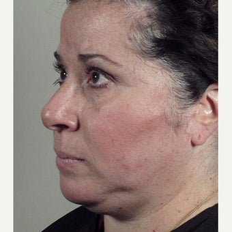 35-44 year old woman treated with Halo Laser after Ultherapy treatment. 1909003