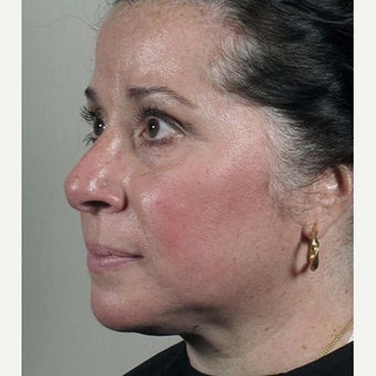 35-44 year old woman treated with Halo Laser after Ultherapy treatment. 1909003