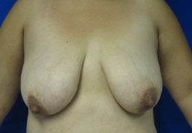 Breast Lift before 3055109