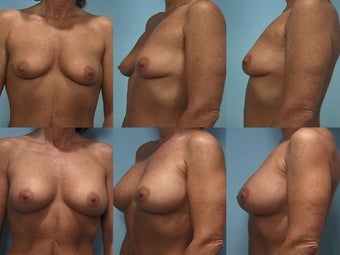 Breast Augmentation Case A to C Cup before 123857