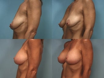 Mastopexy with Breast Augmentation before 124498