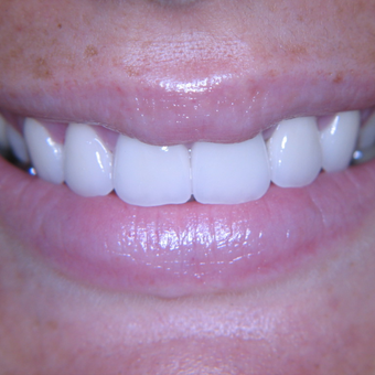 25-34 year old woman treated with Porcelain Veneers after 3770374