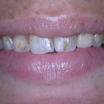 25-34 year old woman treated with Porcelain Veneers before 3770374