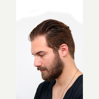 35-44 year old man treated with Organic Hair Transplant before 3172535