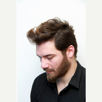 35-44 year old man treated with Organic Hair Transplant after 3172535