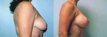 Breast Lift / Breast Augmentation before 351468