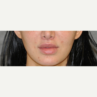 25-34 year old woman treated with Lip Lift after 3175786