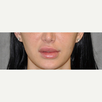 25-34 year old woman treated with Lip Lift before 3175786