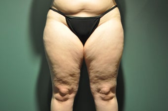 Cellulaze before 1098221