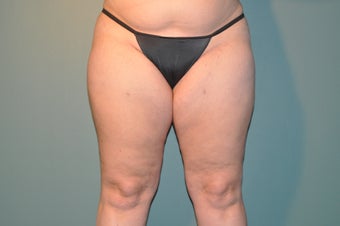 Cellulaze after 1098221