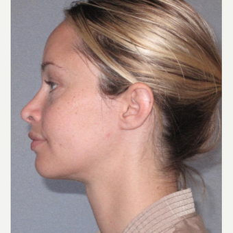 25-34 year old woman treated with Rhinoplasty after 3507714