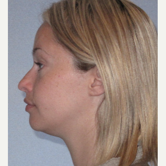 25-34 year old woman treated with Rhinoplasty before 3507714