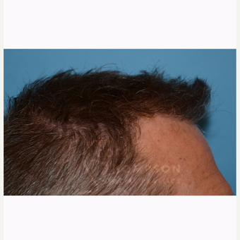 45-54 year old man treated with Hair Transplant after 3366611