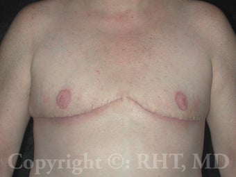 50 yo patient underwent Transgender (F-M) mastectomies ("top surgery") after 309052