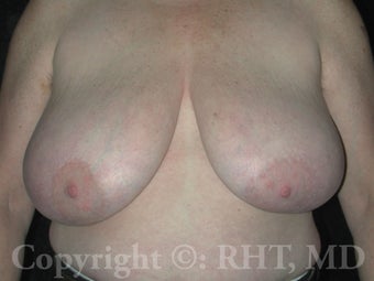 50 yo patient underwent Transgender (F-M) mastectomies ("top surgery") before 309052