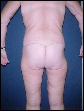 Body Lift after Massive Weight Loss after 470246