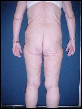 Body Lift after Massive Weight Loss before 470246