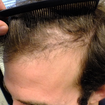 Amazing Result 18-24 year old man treated with FUE Hair Transplant before 2806917