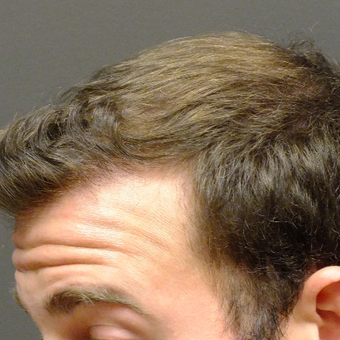 Amazing Result 18-24 year old man treated with FUE Hair Transplant after 2806917