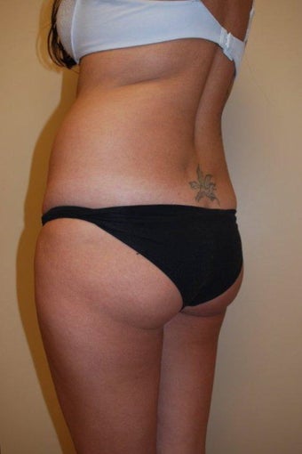 Brazilian Butt Lift before 534386