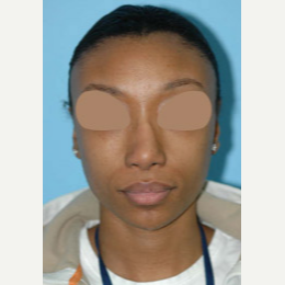 25-34 year old woman treated with African American Revision Rhinoplasty before 3332429