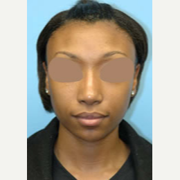 25-34 year old woman treated with African American Revision Rhinoplasty after 3332429