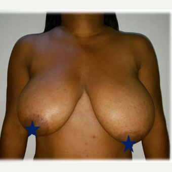 35-44 year old woman treated with Breast Reduction before 3288302