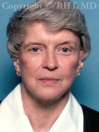 68 yo woman requesting facial rejuvenation after first facelift 15 years ago (elsewhere). after 1169153