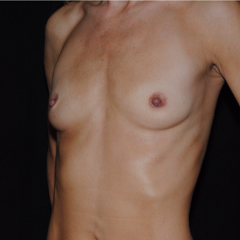 35-44 year old woman treated with Breast Implants before 3849529