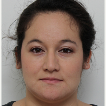 25-34 year old woman treated with Rhinoplasty before 3371703