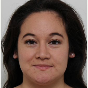 25-34 year old woman treated with Rhinoplasty after 3371703