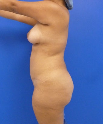 29 y.o. female – Liposuction of abdomen, flanks, and back with fat transfer to buttocks & hips – 1400 cc per side 1127838
