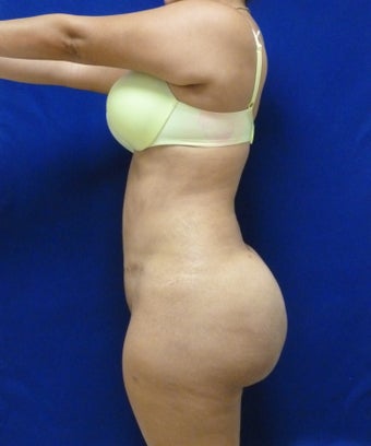 29 y.o. female – Liposuction of abdomen, flanks, and back with fat transfer to buttocks & hips – 1400 cc per side 1127838