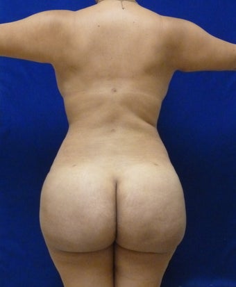 29 y.o. female – Liposuction of abdomen, flanks, and back with fat transfer to buttocks & hips – 1400 cc per side after 1127838