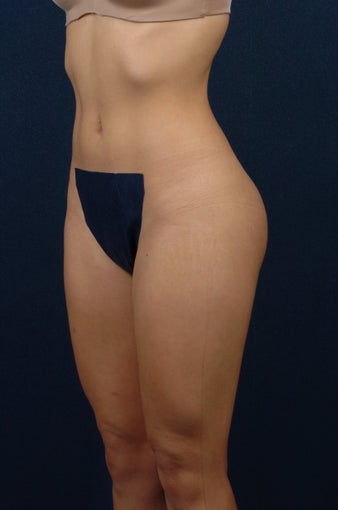 20 Year Old Female - Gluteal Augmentation 362445