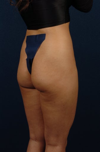 20 Year Old Female - Gluteal Augmentation before 362445