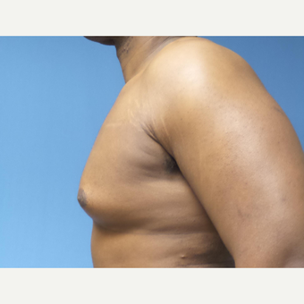 35-44 year old man treated with Male Breast Reduction before 3678083