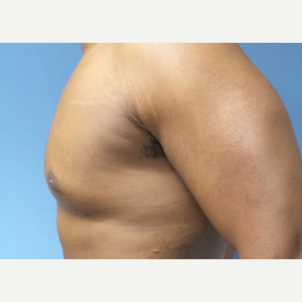 35-44 year old man treated with Male Breast Reduction after 3678083