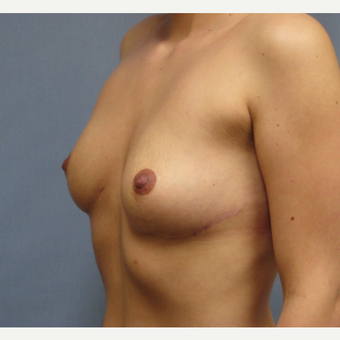 25-34 year old woman treated with Breast Implant Removal after 3300910