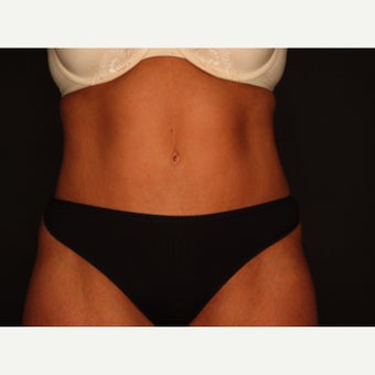 45-54 year old woman treated with Smart Lipo after 2081201