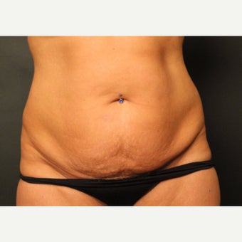 45-54 year old woman treated with Smart Lipo before 2081201