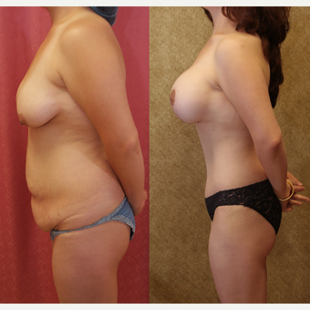 35-44 year old woman treated with Mommy Makeover 3289150