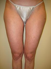 Smart Lipo 1027792