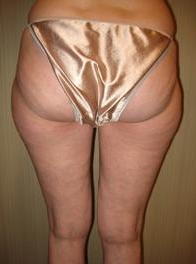 Smart Lipo before 1027792