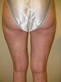 Smart Lipo after 1027792